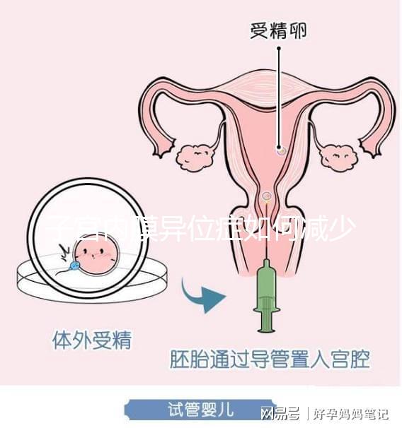 子宮內膜異位癥如何減少手術次數,增加試管嬰兒成功率?