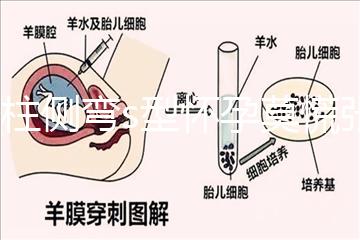 脊柱側彎s型懷孕莫慌張，能否順產還得看這4大要素