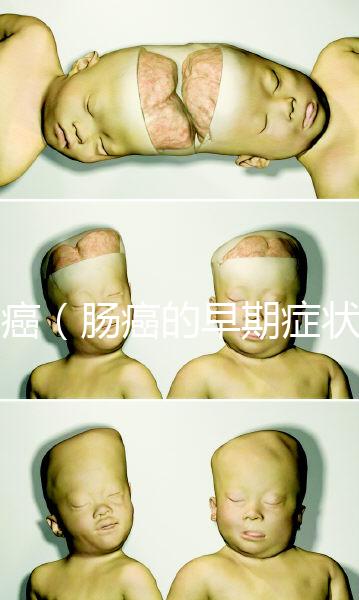 腸癌(腸癌的早期癥狀有哪些)