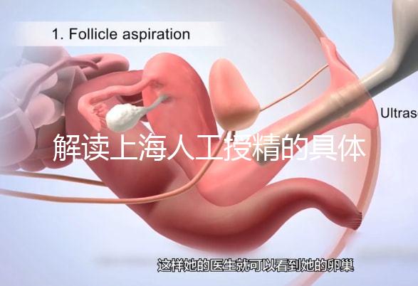 解讀上海人工授精的具體過程，會不會痛看醫生怎么說？