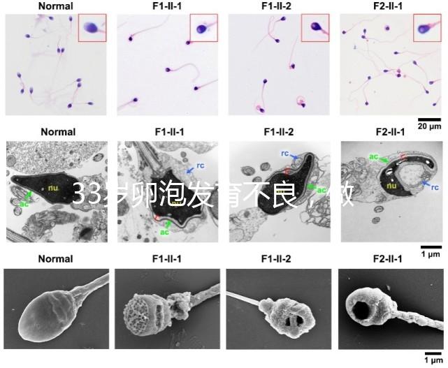 33歲卵泡發育不良,做試管黃體期促排方案失敗怎么辦?